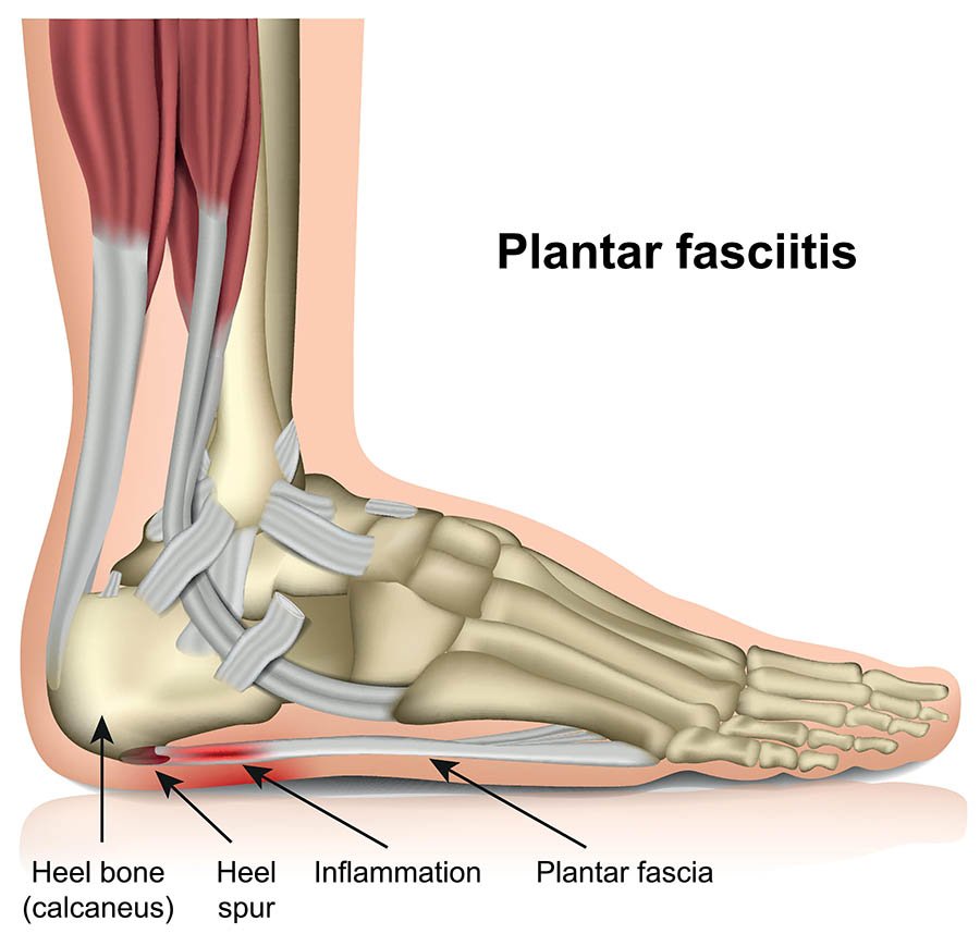 Shockwave Therapy for Plantar Fasciitis — Does It Really Work?