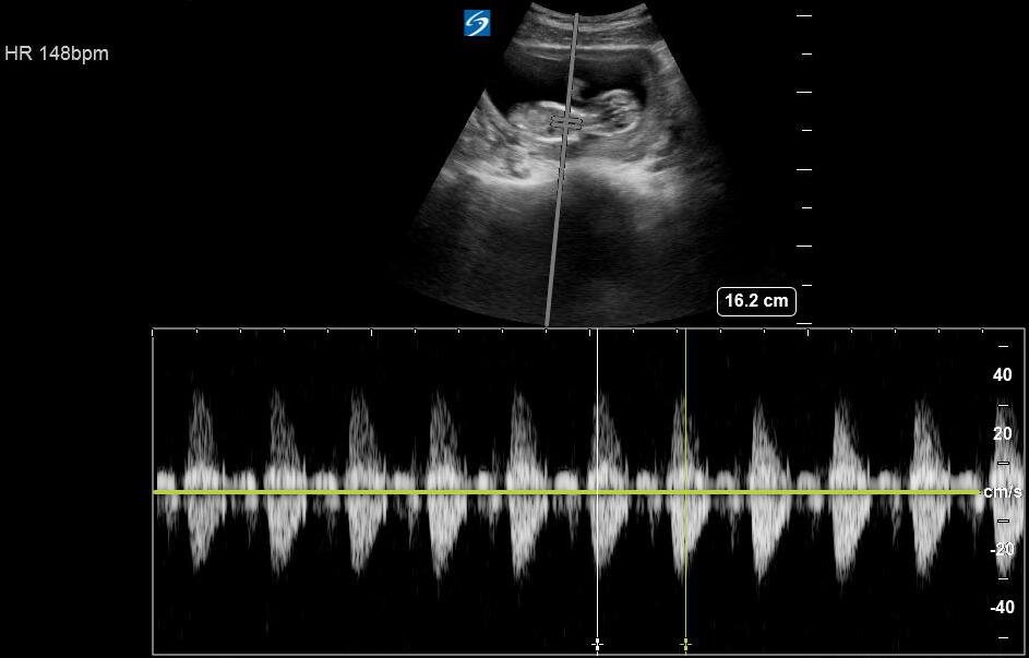 Doppler (No) | ALARA | Fetal Heart — Everyday Ultrasound