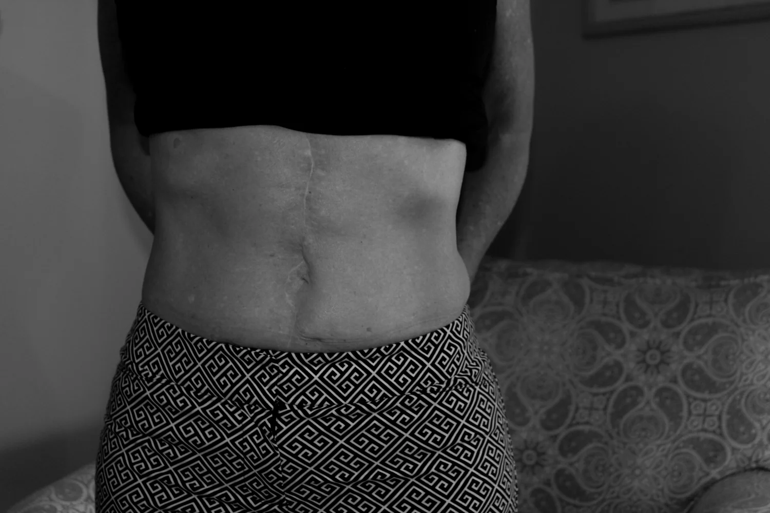Anne Grahumn’s scar after having extensive surgery in 2015 to combat ovarian cancer.