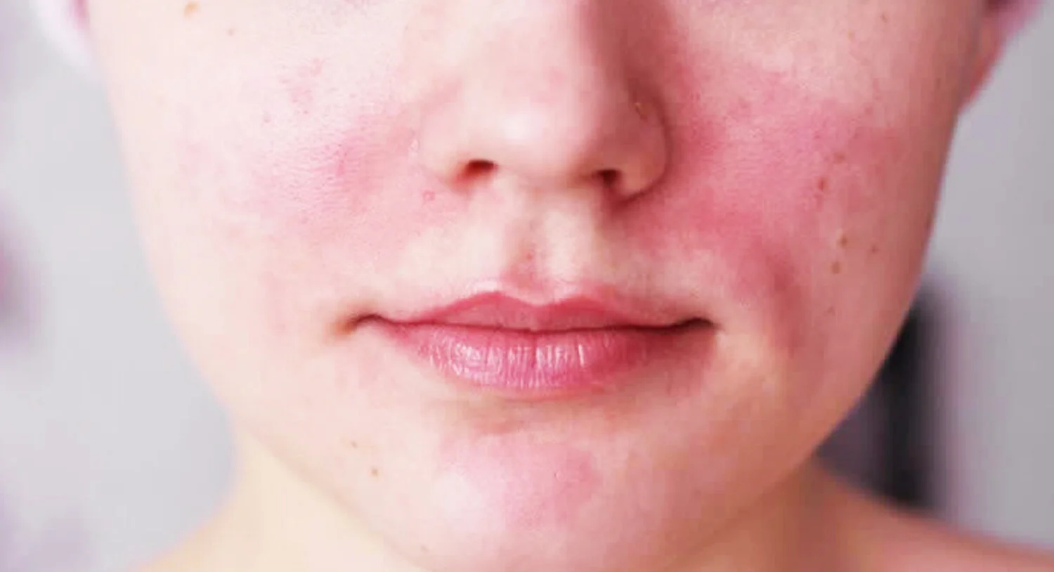 All About Rosacea 