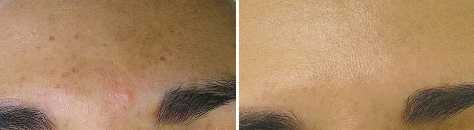 Hydrafacial1.jpg