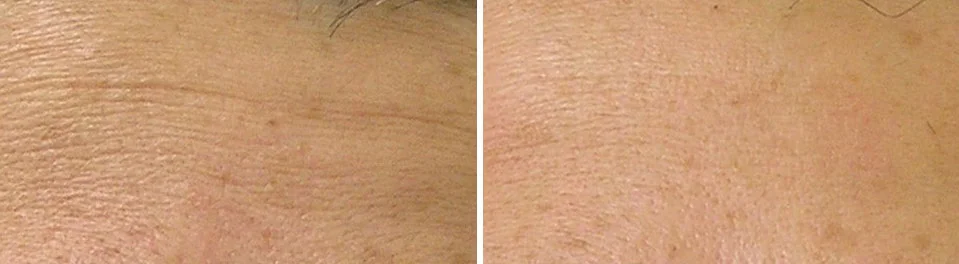 Hydrafacial2.jpg