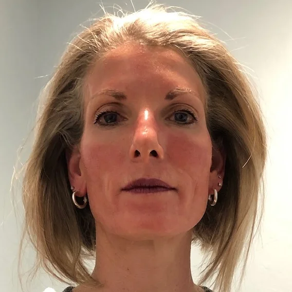 Micorneedling1.jpg
