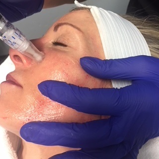Micorneedling2.jpg