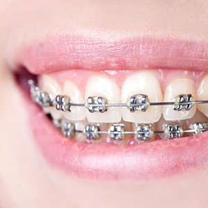 Traditional Braces