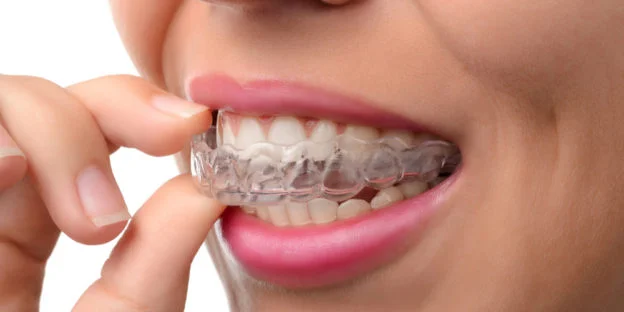 invisalign-banner-624x312.jpg
