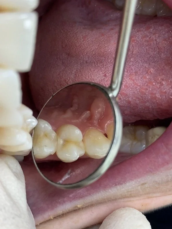 Restorations of Proximal Caries Lesions — Infinix™ Advanced Dental