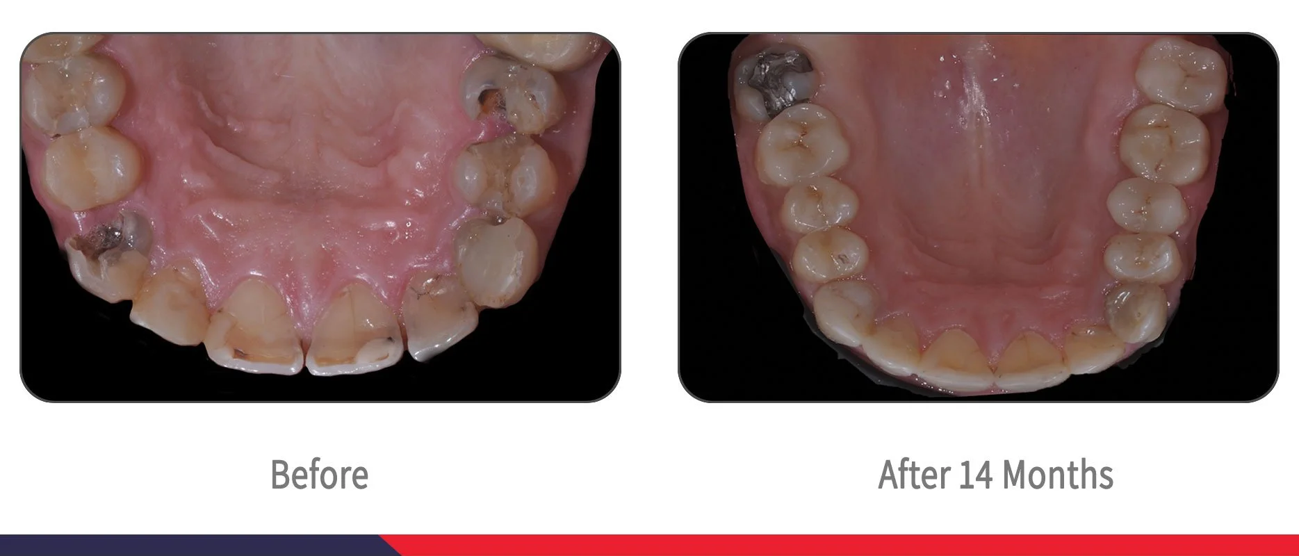 Rampant Caries in Adult Before and After 14 Months — Infinix™ Advanced