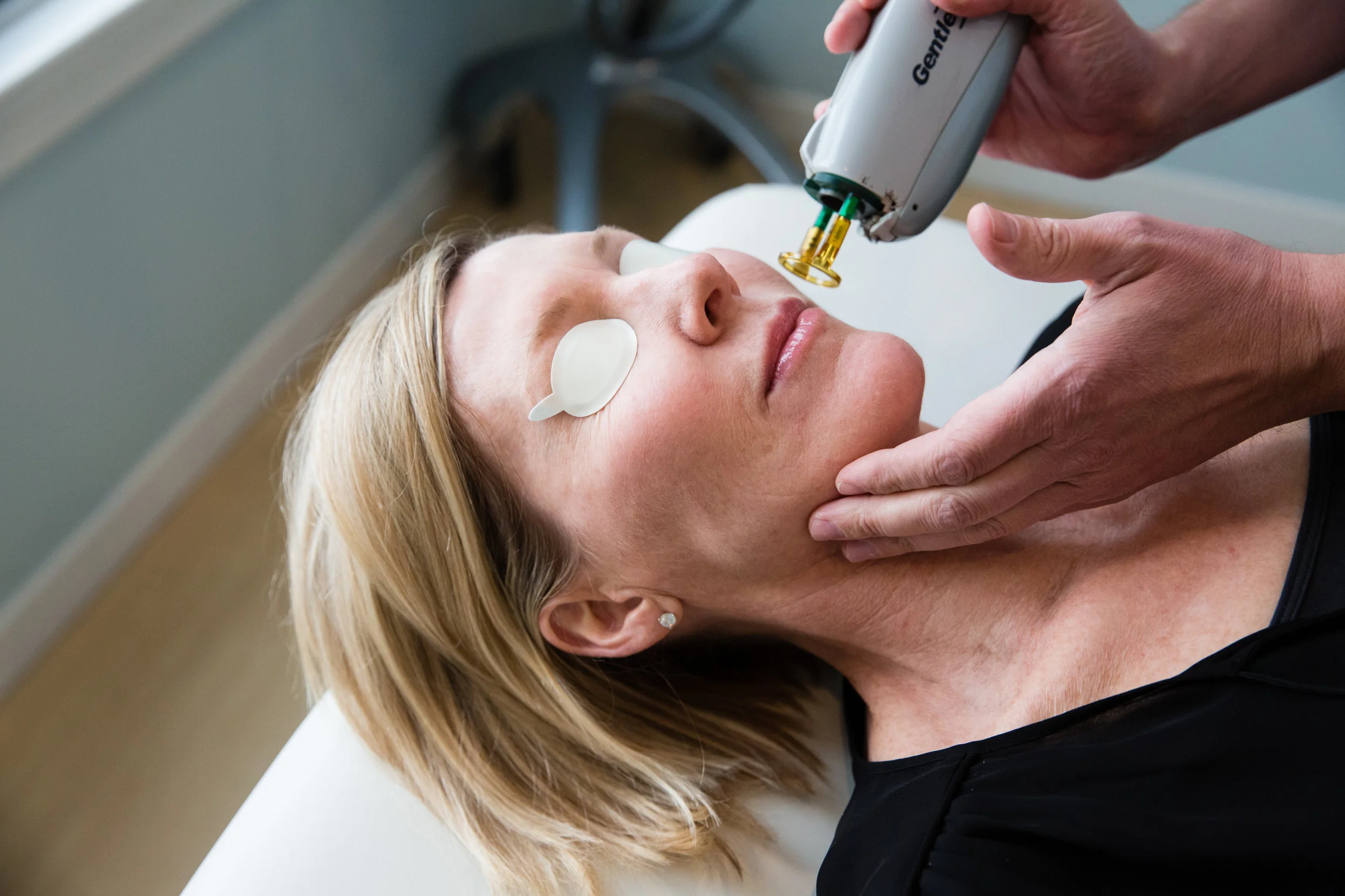 Laser-Skin-Rejuvenation-in-San-Francisco-Bay-Area