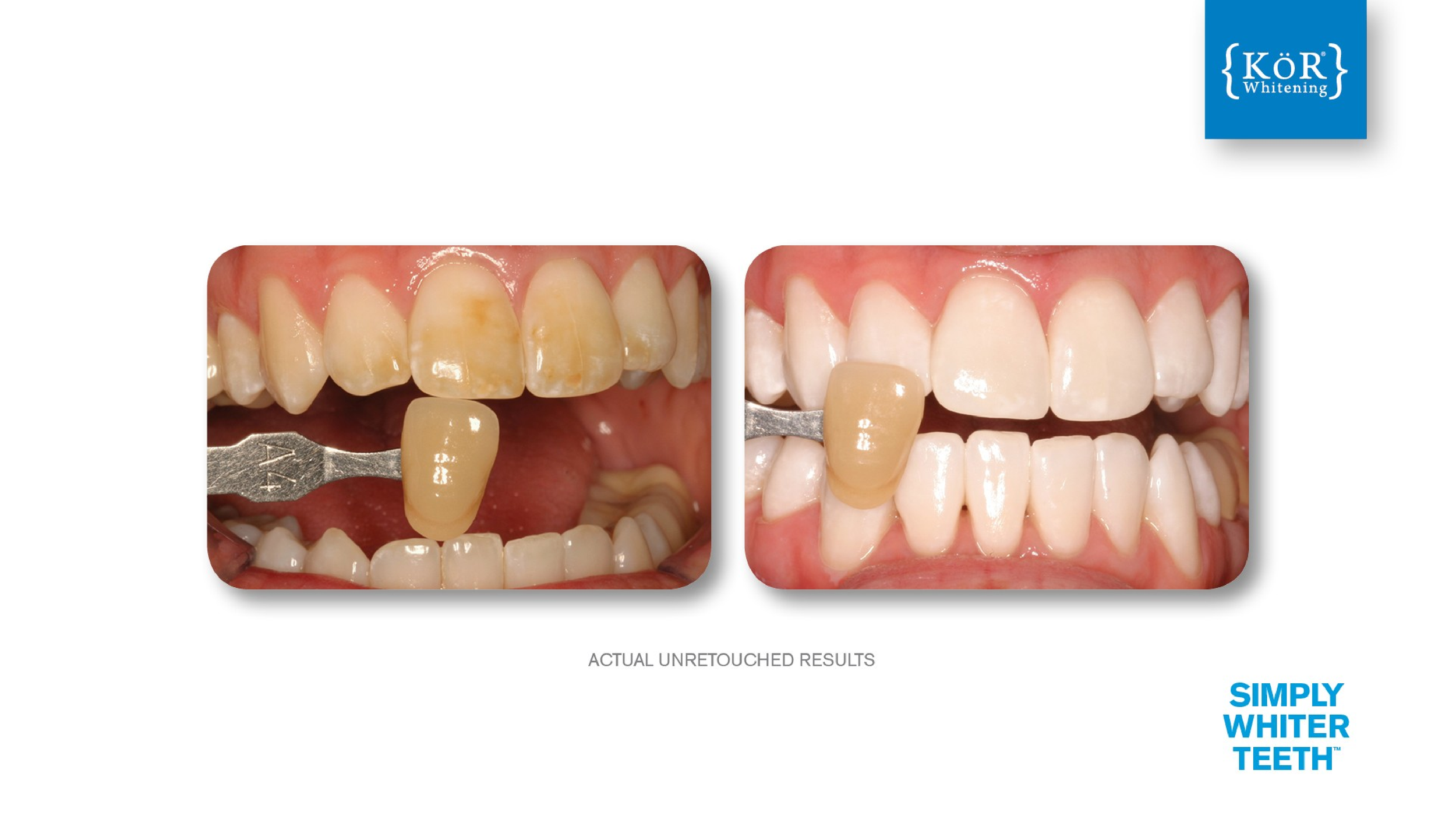 KöR Whitening — Michael Jones Dental Corporation