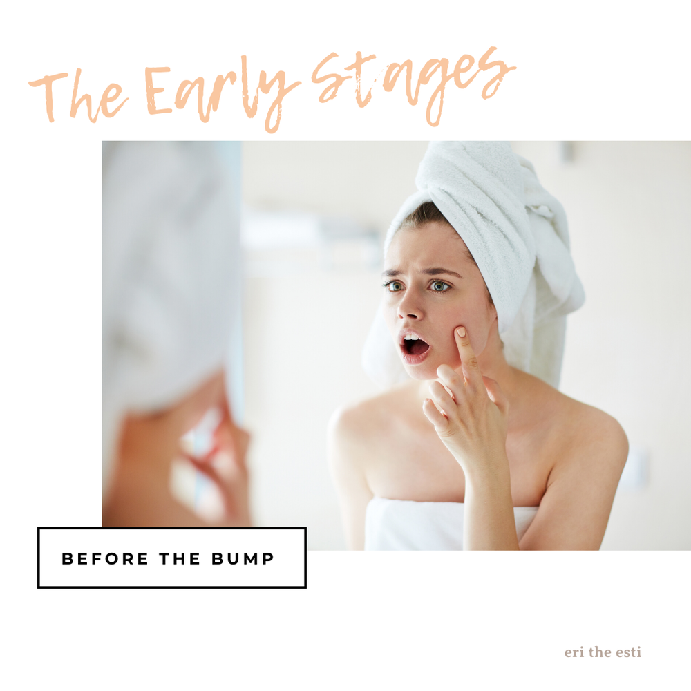 Ask A Pro: How to Treat a Pimple