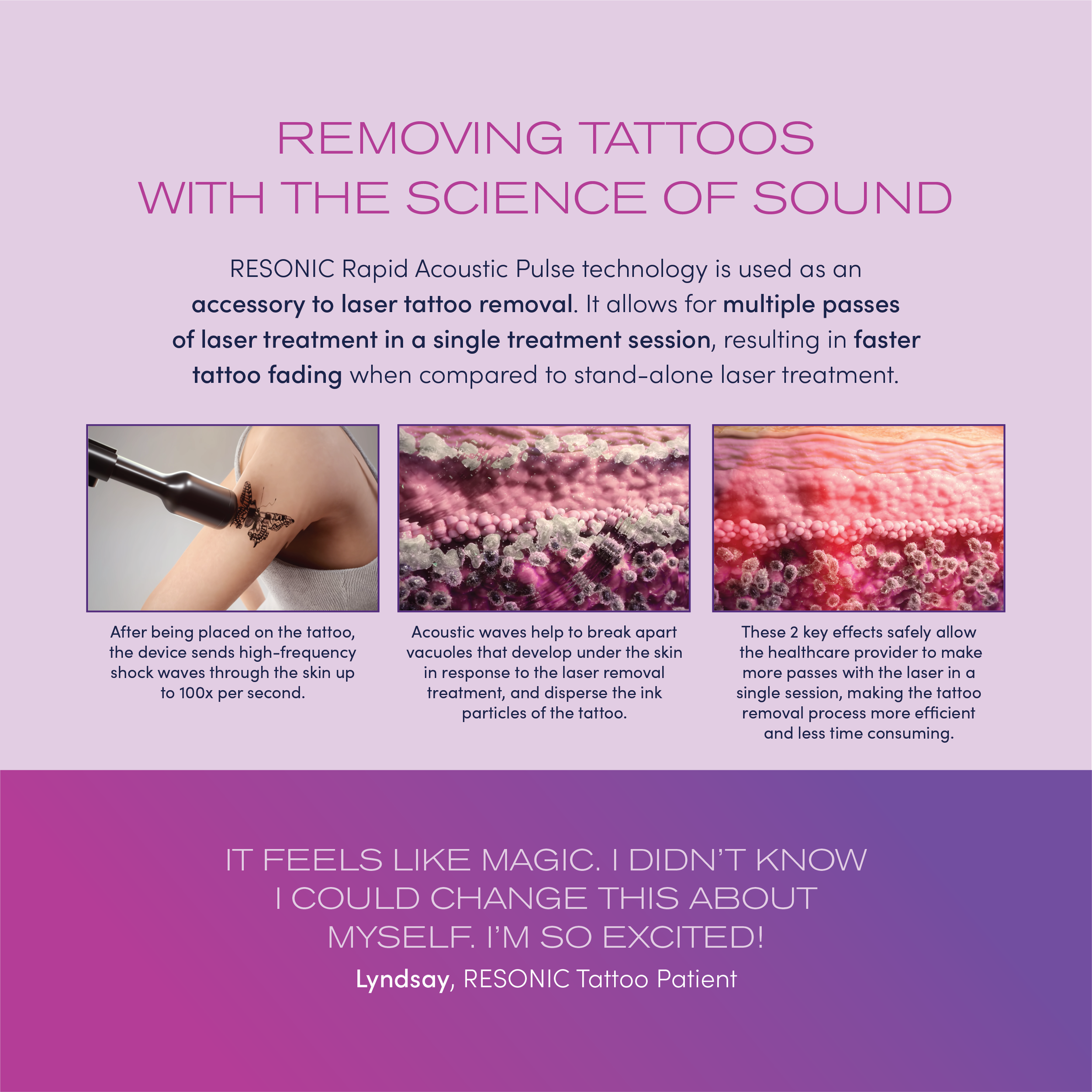 Resonic Laser Tattoo Removal NYC  Coolspa
