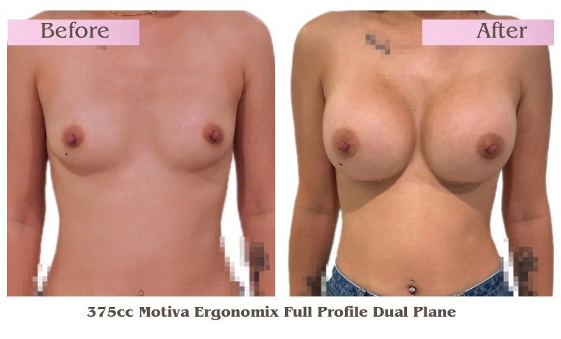 Breast Augmentation_1.jpg