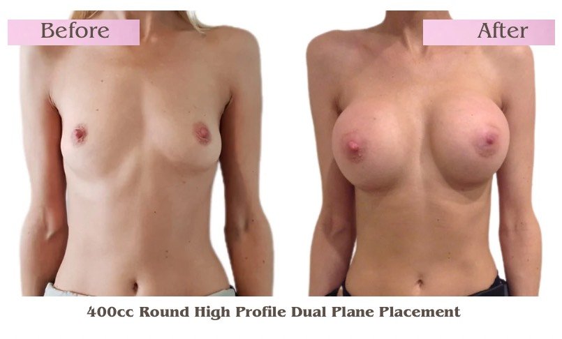 Breast Augmentation_15.jpeg