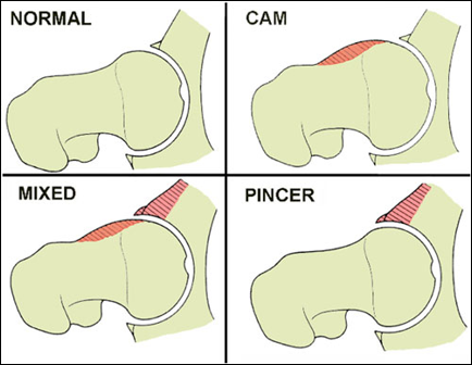 What is Hip Impingement? — Accelerated Sports Therapy