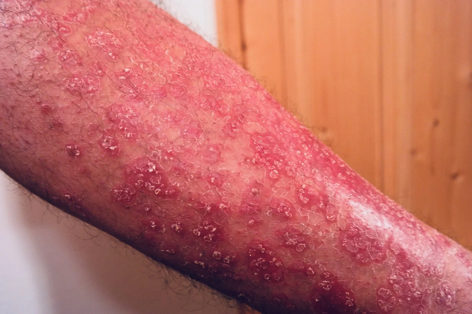 psoriasis-356429_1920 1500px.jpeg