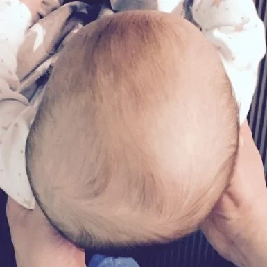plagiocephaly.jpg
