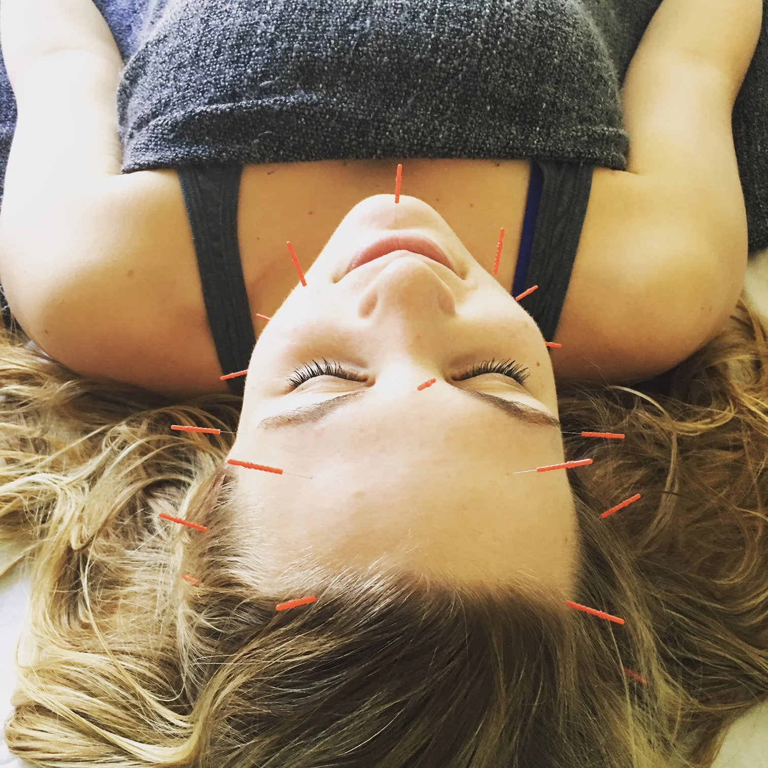 accupuncture_facial.jpg