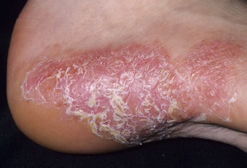 This type of psoriasis often causes thick patches of skin that are covered with silvery-white scale.