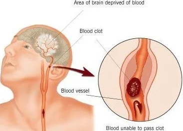 Cerebrovascular Disease