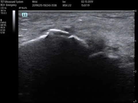 Distal radius fracture