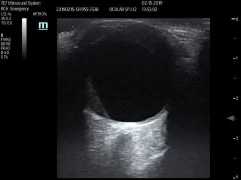 Stent with occluded R CFA