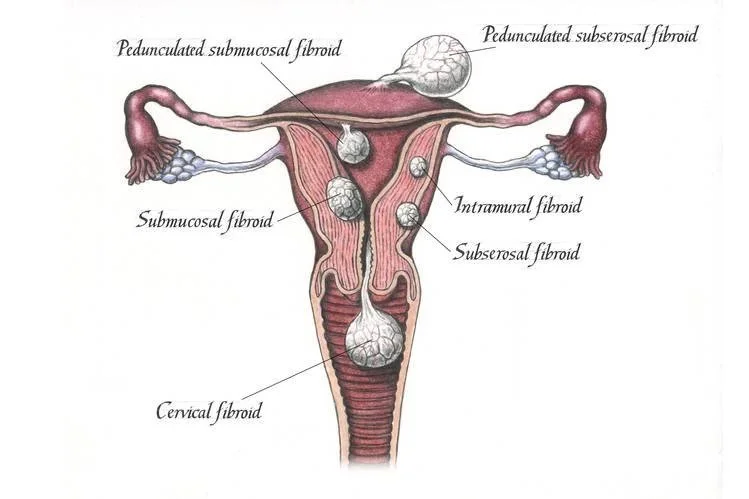 Empowering Women's Health: Managing Uterine Fibroids Through Functional Medicine