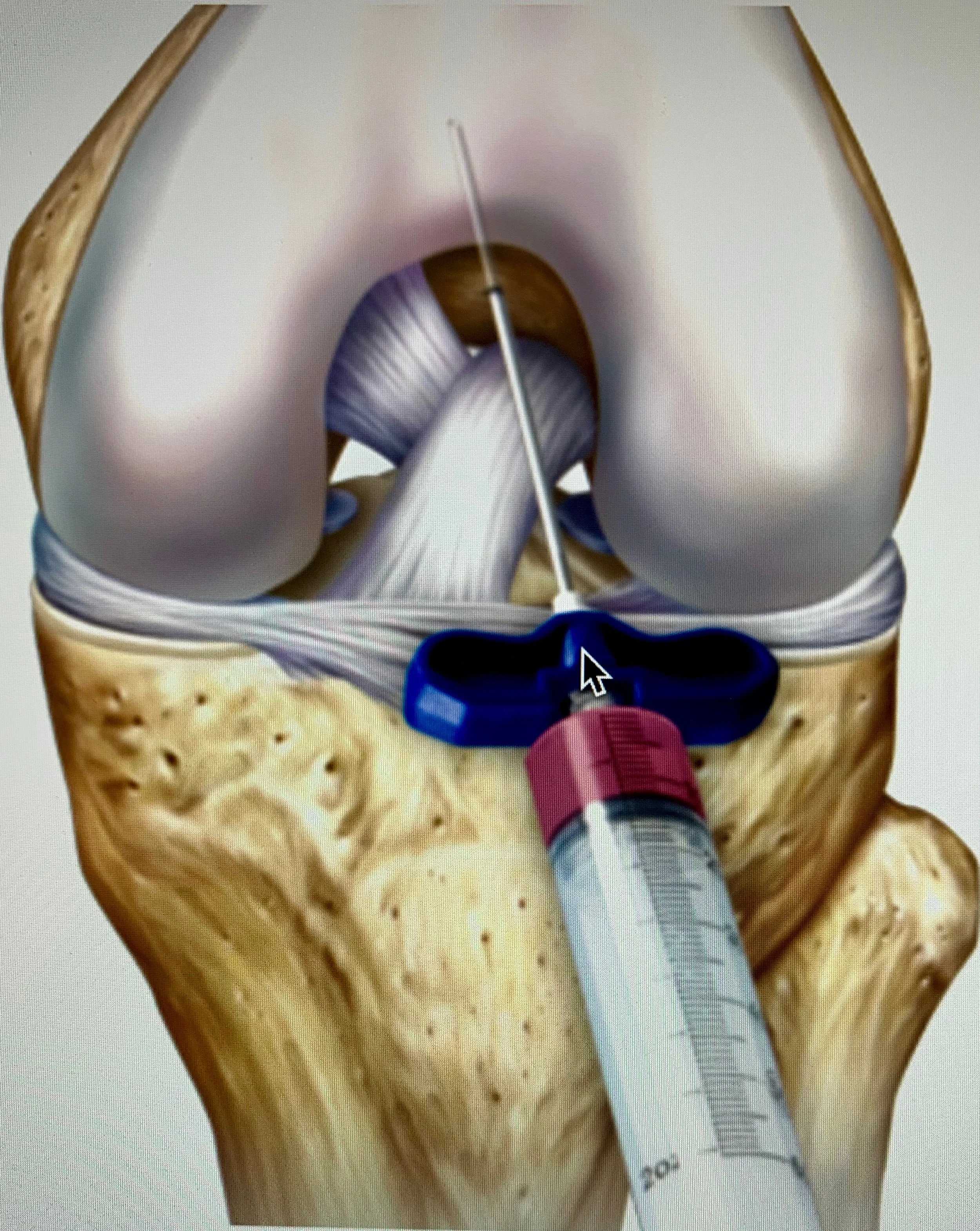Knee aspiration.jpeg