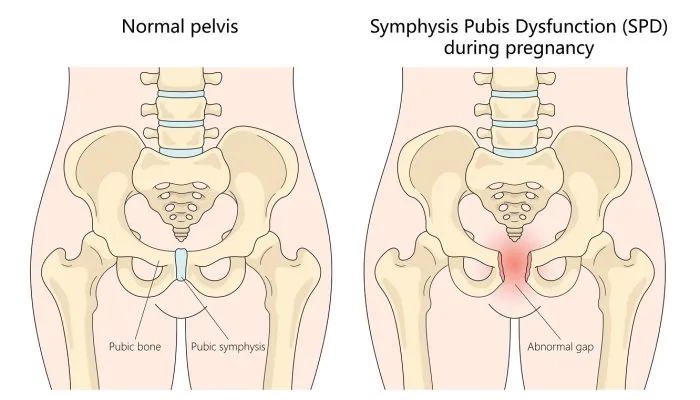 Symfysesmerter i svangerskapet: Når bør du søke hjelp?