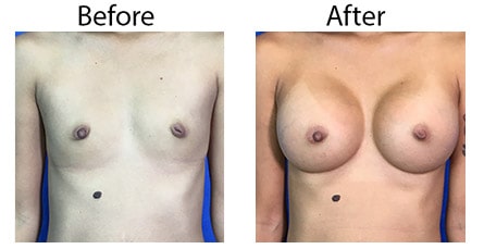 Los_Angeles_Breast-Augmentation_Case-1.jpg