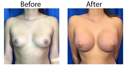 Los_Angeles_Breast-Augmentation_Case-2.jpg