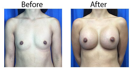 Los_Angeles_Breast-Augmentation_Case-4.jpg