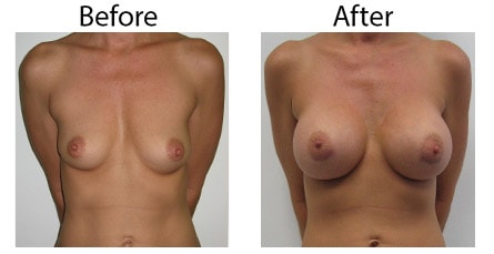 Los_Angeles_Breast-Augmentation_Case-6.jpg