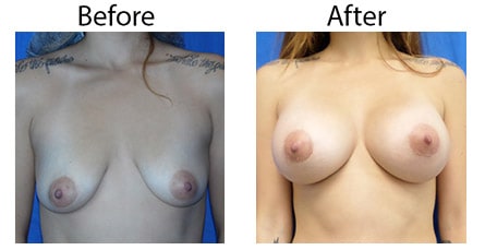 Los_Angeles_Breast-Augmentation_Case-8.jpg