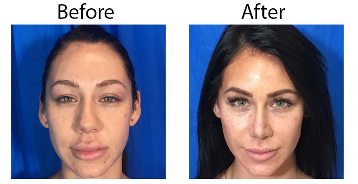 los-angeles-Rhinoplasty2.jpg