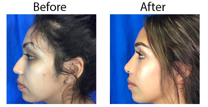 los-angeles-Rhinoplasty5.2.jpg