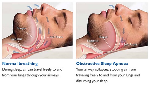 sleep-apnea.jpg