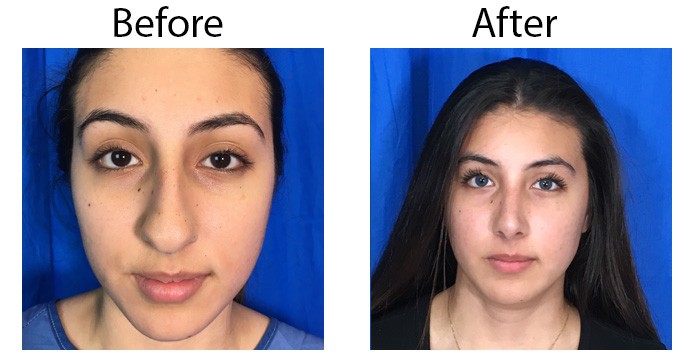 los-angeles-Rhinoplasty1-1.jpg