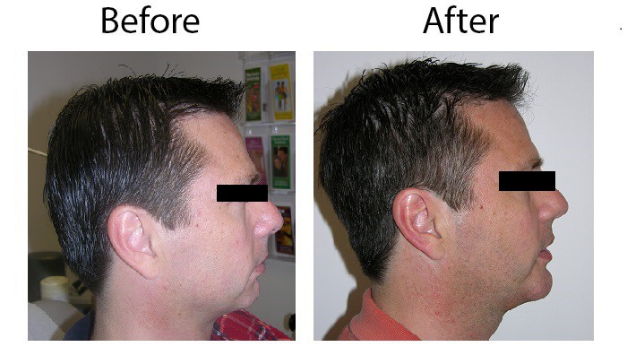 Los_Angeles_Chin_Augmentation_Case-3-01-1.jpg