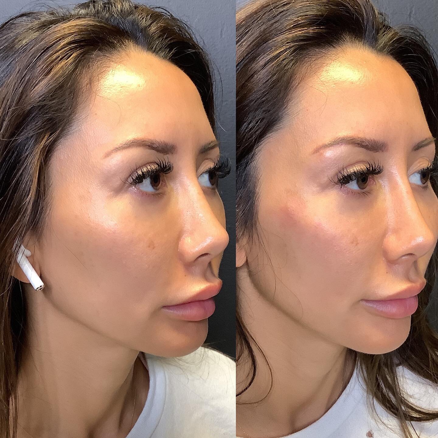 Subtle upper cheek enhancement on this gorgeous patient.
-
-
We used 0.5ml on each side of Restalyne Lyft 
-
-
The little bump is the injection point and will go away