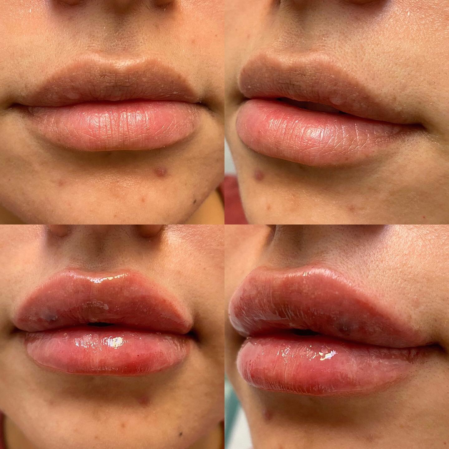 Beautiful Restalyne Kysse lips done by @inject.with.lexx 
-
-
☎️ (909)766-8710
📍1980 N Orange grove ave, Pomona CA