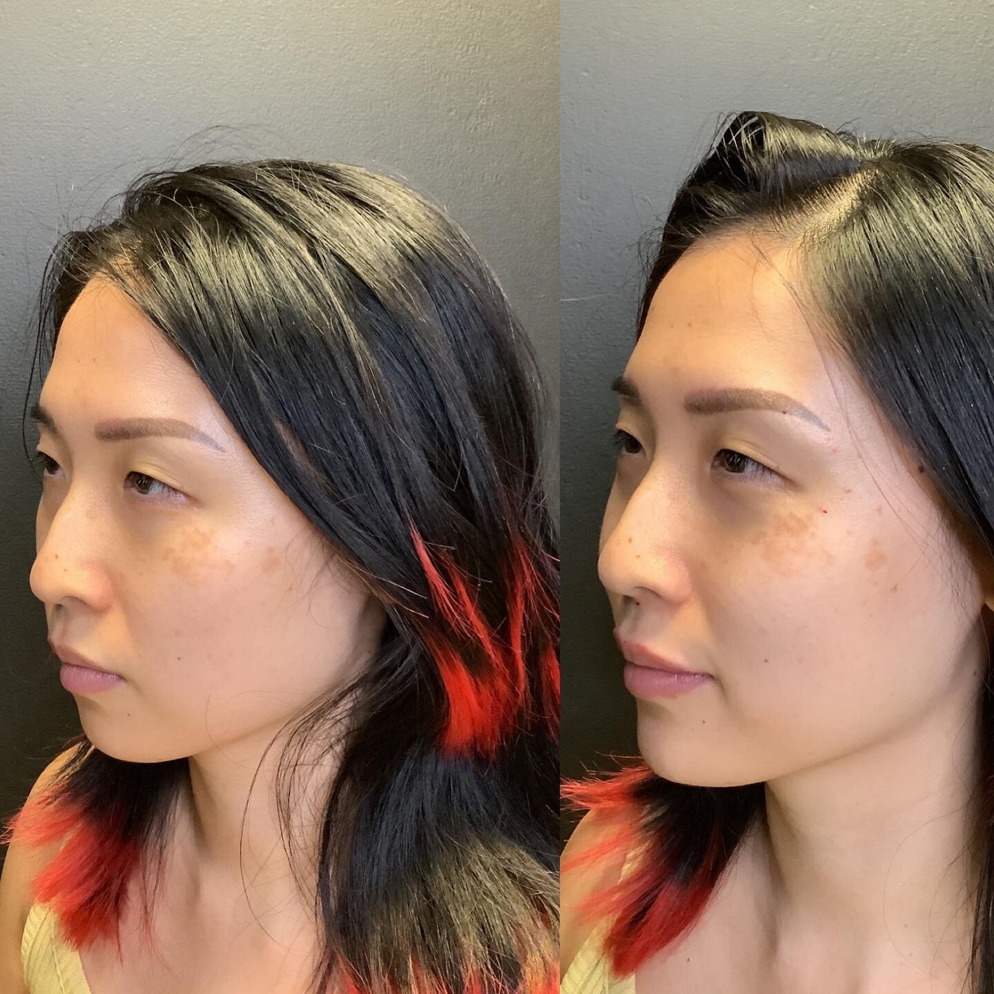 Profile balancing -1ml of filler in her chin 
-
-

the relationship between the nose, lip and chin from the profile view (side-on view of the face). Dermal fillers can be used very effectively to achieve a more balanced and aesthetic profile.