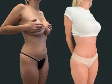 dr-michael-omidi-brazilian-butt-lift-and high-definition-liposuction-beverly-hills (2).jpg
