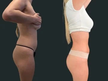 dr-michael-omidi-brazilian-butt-lift-and high-definition-liposuction-beverly-hills (3).jpg