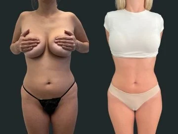 dr-michael-omidi-brazilian-butt-lift-and high-definition-liposuction-beverly-hills.jpg