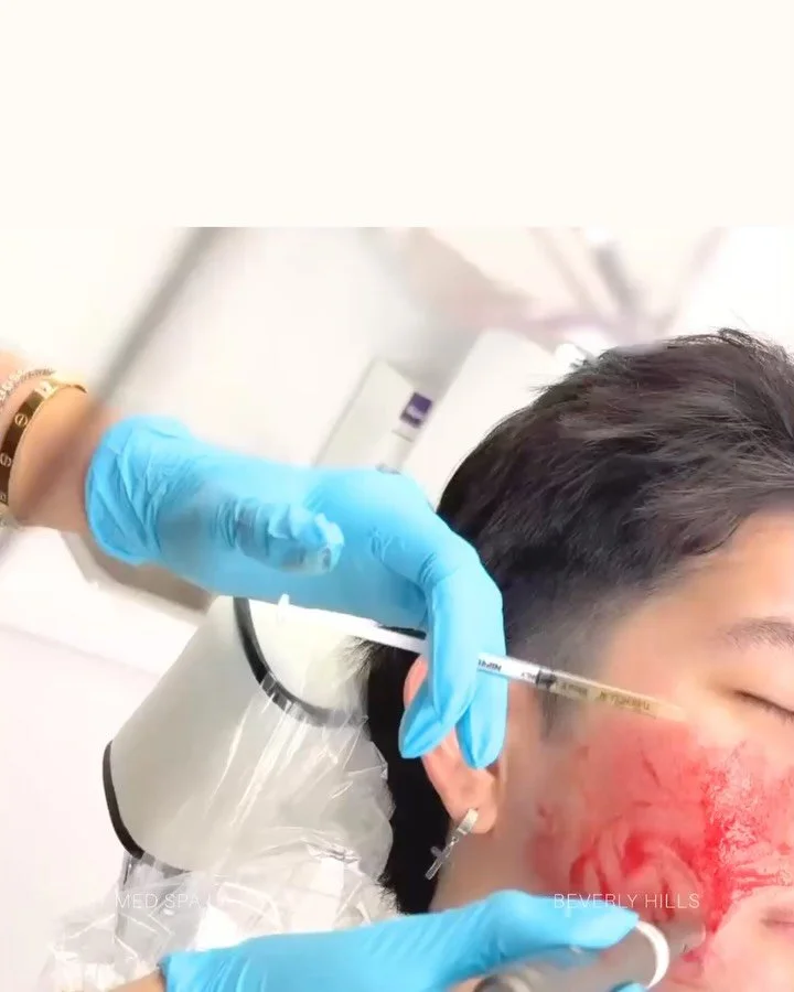 The science of skin renewal. ✨
Vampire Facial combines microneedling with Platelet-Rich Plasma (PRP) to support natural skin rejuvenation.
A personalized approach to improving fine lines, uneven texture, and certain acne scars.
Refined skin starts wi
