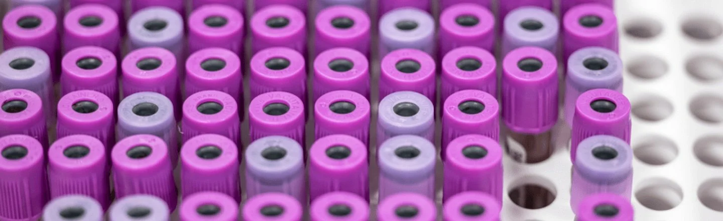 Blood test shows potential as way to screen for early-onset colorectal cancer