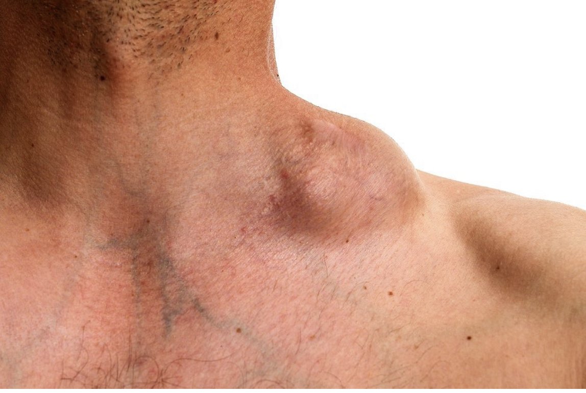 Fatal Implant-Associated Lymphoma After Buttock Enhancement