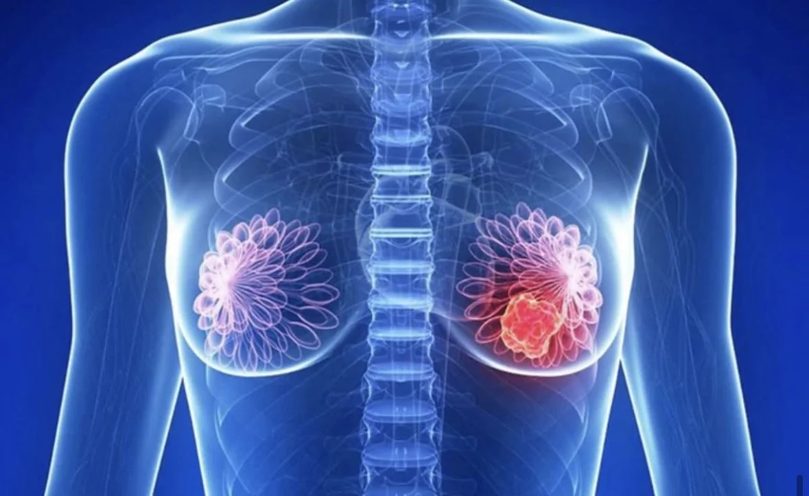 FDA Approves First Immunotherapy for Breast Cancer