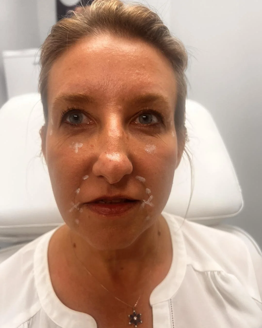 As promised! Little touch up to the corners of my lips, filled in the dark, under my eyes, filled in those nasal labial folds. 

A lot can happen with one syringe of filler and a little bit of Xeomin. 

We&rsquo;re ready when you are for your little 